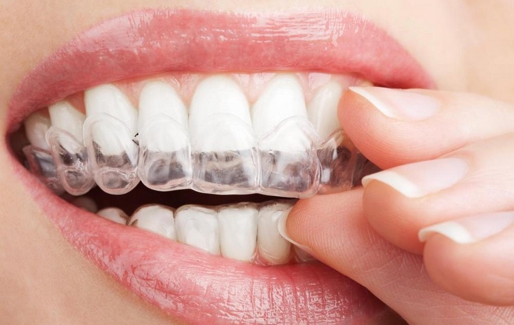 blanchiment des dents technique maison kit dentiste avantages inconvénients