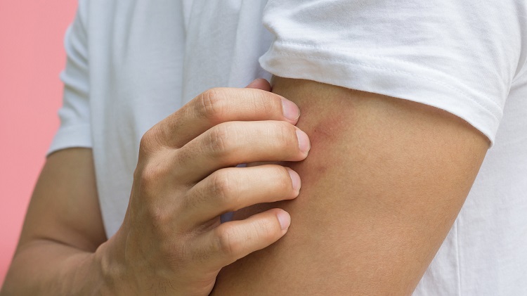 piqûres de moustiques astuces conseils allergies symptômes