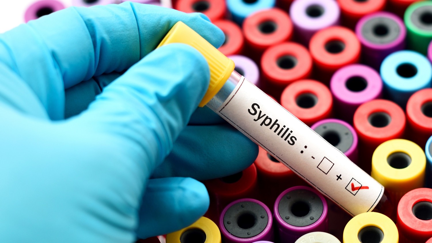 cas de syphilis en Europe recrudescence