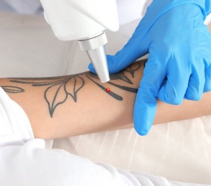 enlever un tatouage méthodes facteurs importants