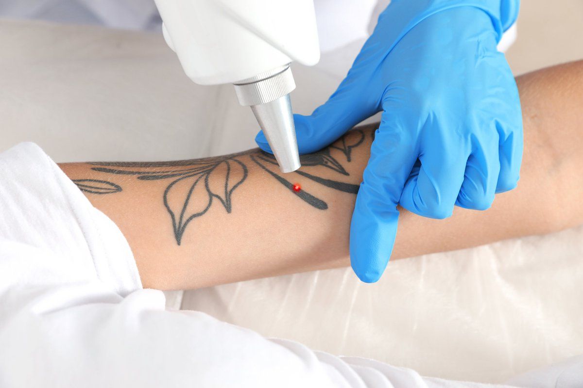 enlever un tatouage méthodes facteurs importants