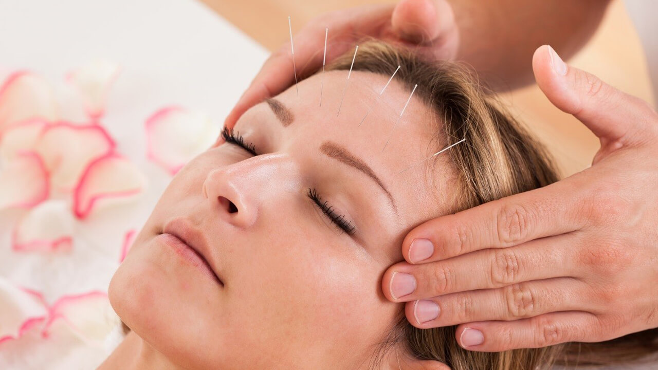 soulager une migraine acupuncture méthode efficace