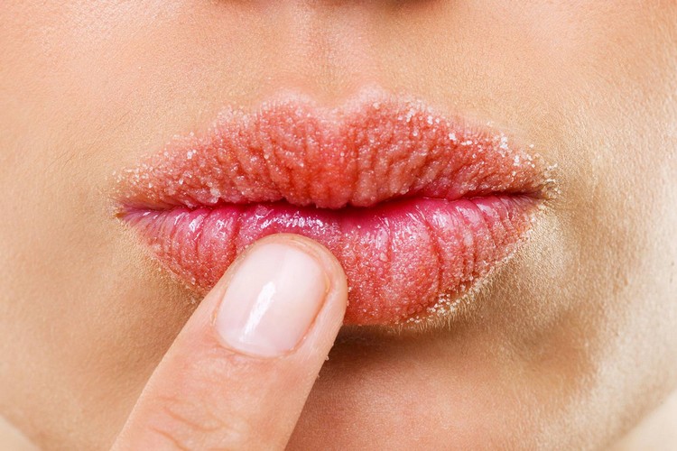 lèvres crevassées causes rayons UV déshydratation