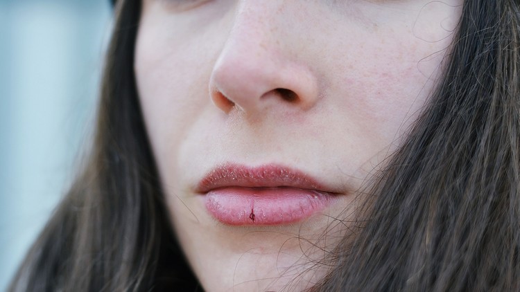 lèvres gercées cause conseils traitement astuces de grand-mère soin naturel