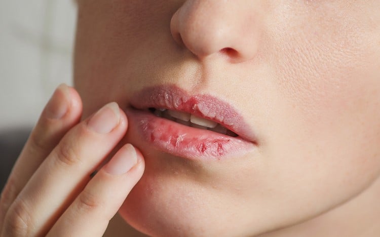 lèvres sèches endommagées causes carences en vitamines allergies