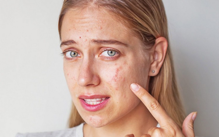 Qu'est-ce qui cause l'acné déclencheurs mythes information générale