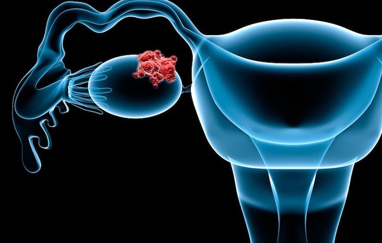 cancer des ovaires talc lien dementi