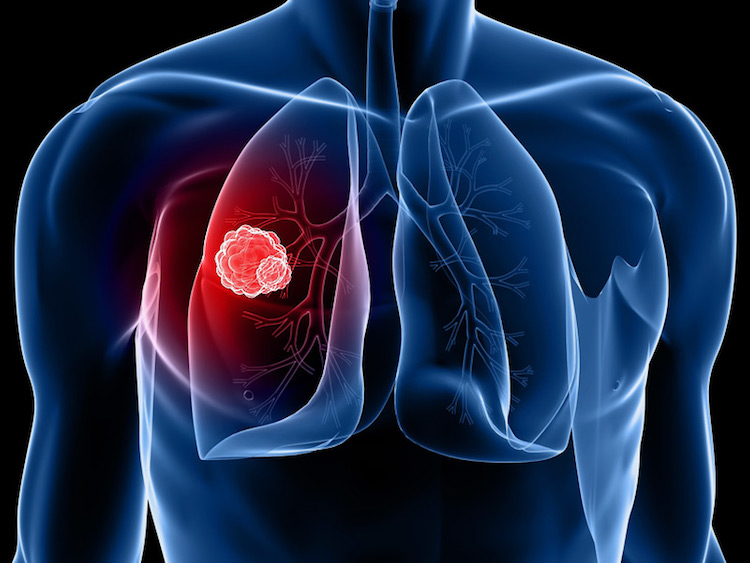 cancer du poumon immunotherapie