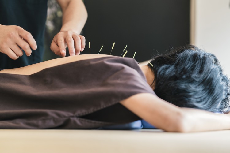 acupuncture aiguilles médecine alternative chinoise vertus santé