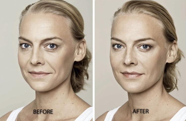 avant-après injection skinbooster acide hyaluronique revitalisation peau