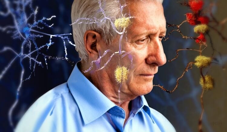 facteurs de risque maladie alzheimer démence trouble cérébral