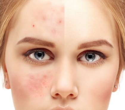 cure cutanée huilles essentielles anti-acné peau impeccable