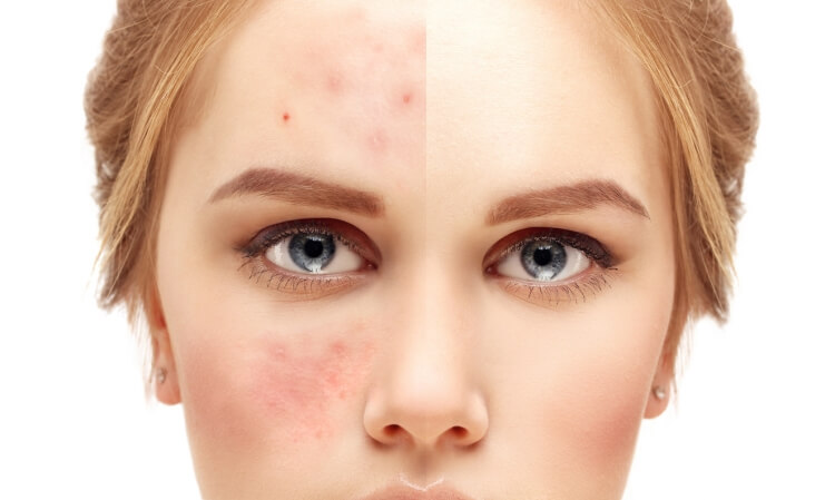 cure cutanée huilles essentielles anti-acné peau impeccable