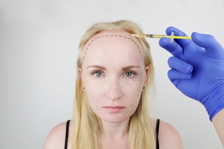 greffe de cheveux femme chirurgies capillaire douce micro cicatrices