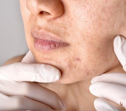 acné et alimentation quels aliments à privilégier conseils peau saine