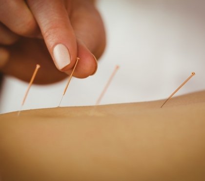 bienfaits de l'acupuncture vertus santé médecine douce chinoise thérapie aiguilles