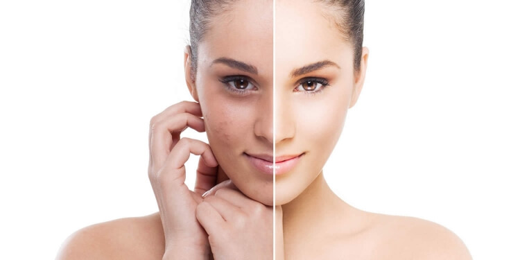 peeling chimique visage procédure cosmétique soin visage