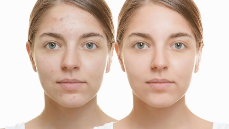 soin visage anti-acné points noirs acide salicylique