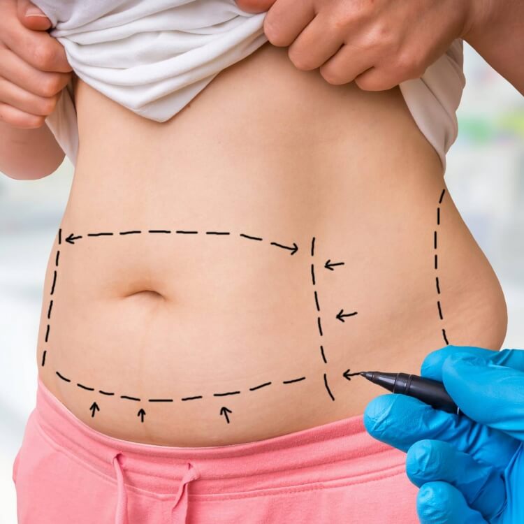 cellulite causes liposuccion solution effets néfastes apparence