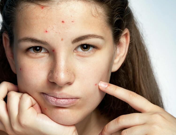 comment faire disparaître acné visage adulte