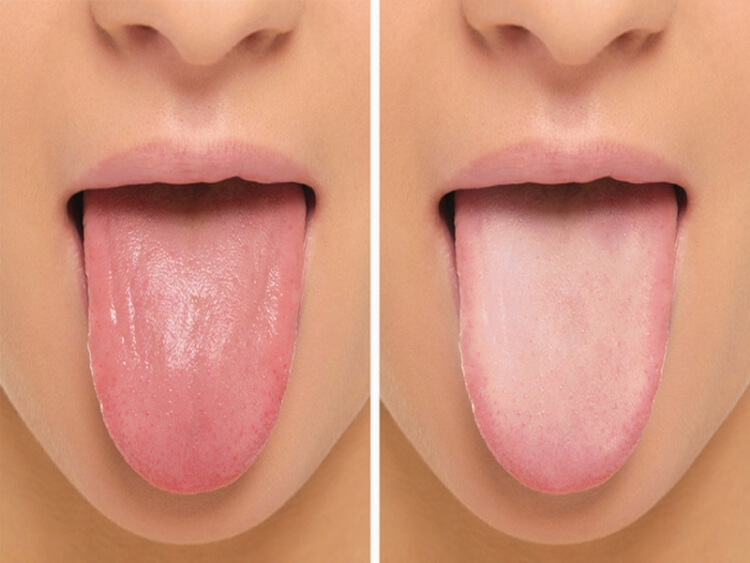 symptômes déficit de fer langue gonflée et enflammée