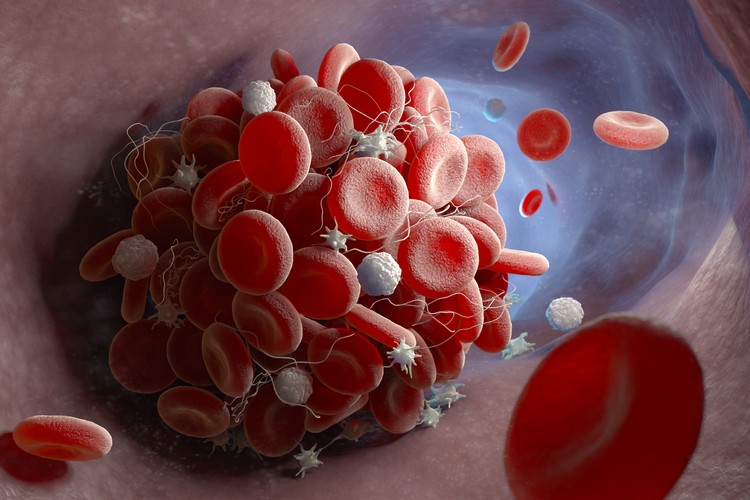 caillots sanguins formes sévères Covid-19 association aux anticorps nouvelle étude thrombocytes