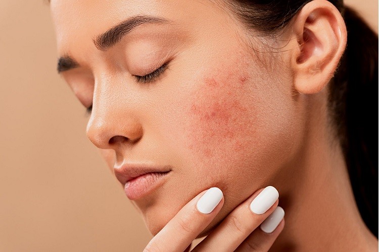 Comment traiter l hyperpigmentation