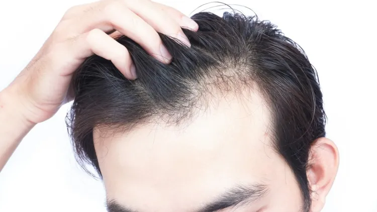 chute de cheveux homme calvitie sommet tête cause hérédité