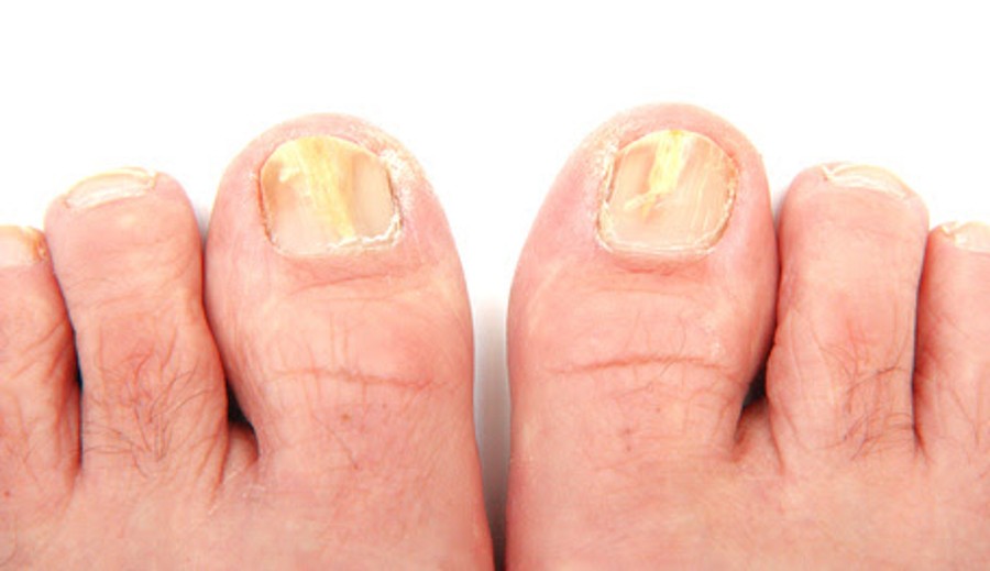 bicarbonate et mycose des pieds