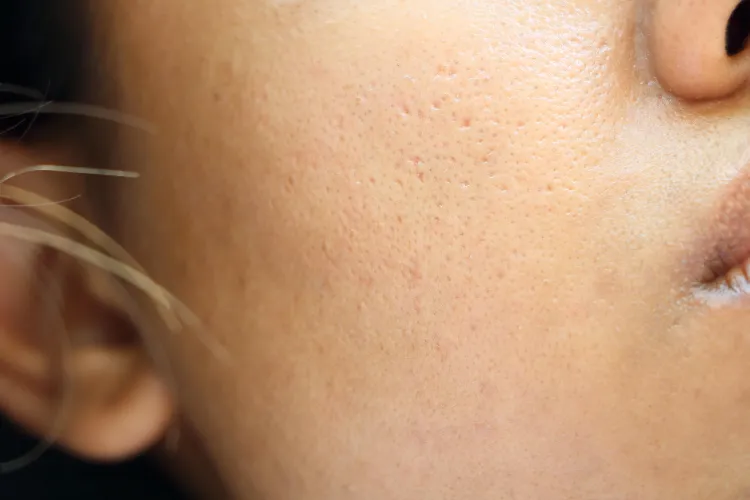 causes pores dilatés astuces simples resserrer sans laser solution radicale