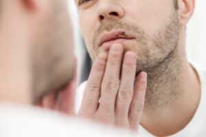 herpes traitement naturel remèdes de grand-mère changement alimentation
