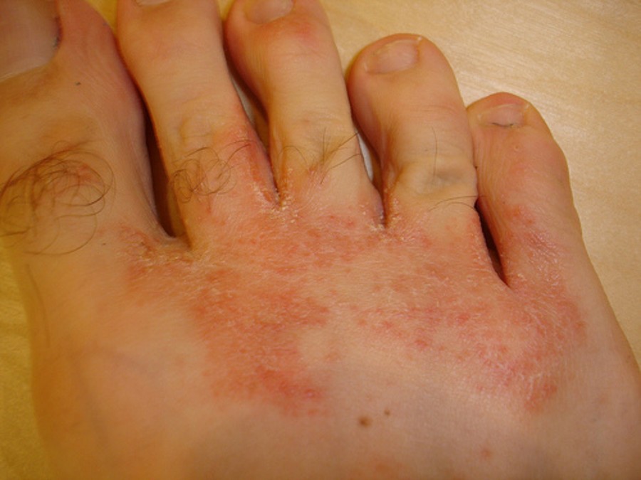 mycose ongle de pied bicarnonate