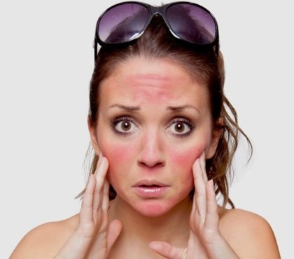 SOS coup de soleil visage et lèvres Que faire traiter brulures causées rayons UV