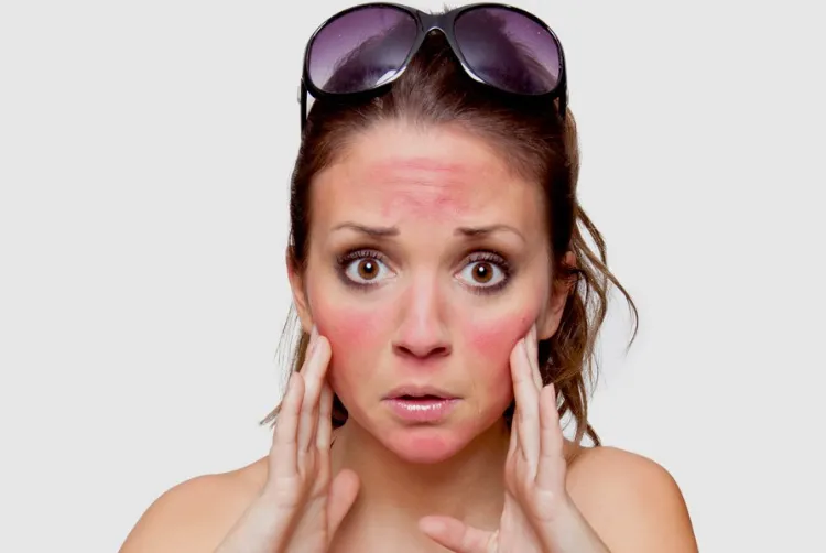 SOS coup de soleil visage et lèvres Que faire traiter brulures causées rayons UV