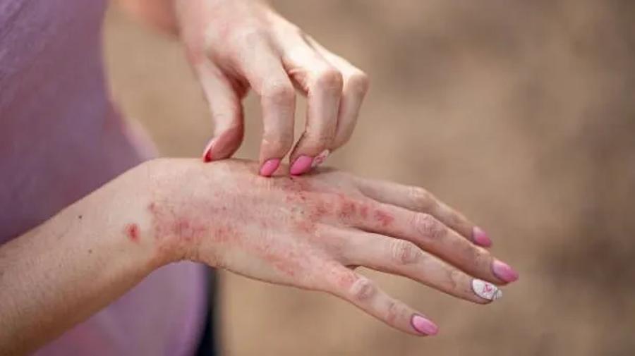 jasmin allergie
