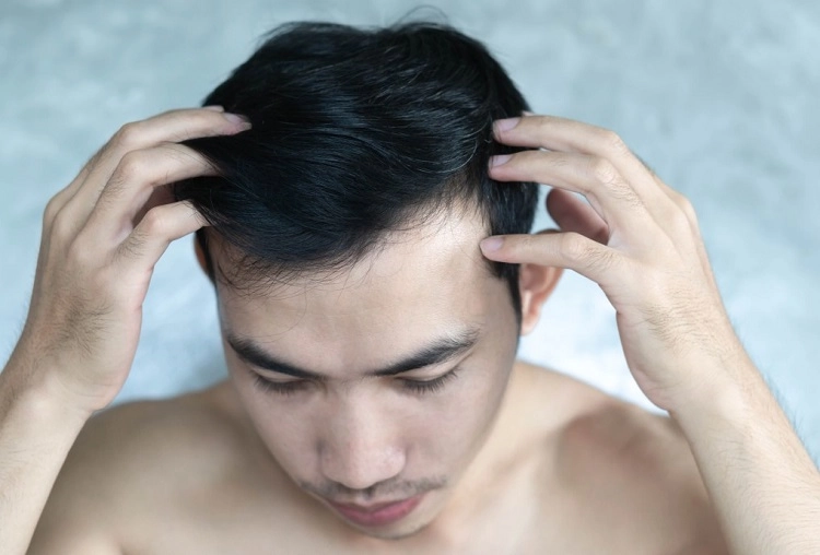 perte de cheveux devant homme