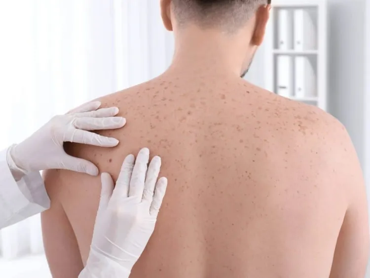 boutons cancer de la peau zones touchées humidité aisselles cou aine