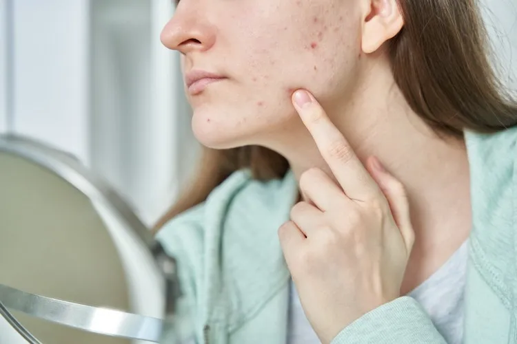 comment utiliser lotion assechante bouton acne soin anti-imperfection peau zéro défaut