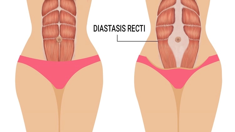 diastasis recti causes