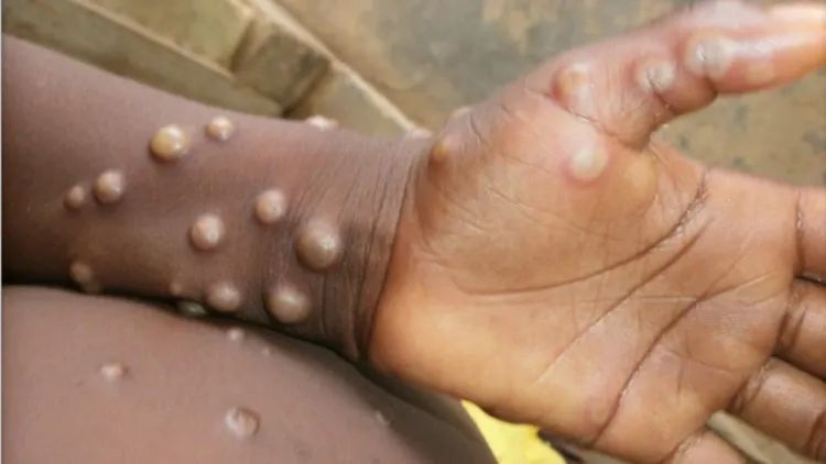 pustules virus de la variole du singe 2022