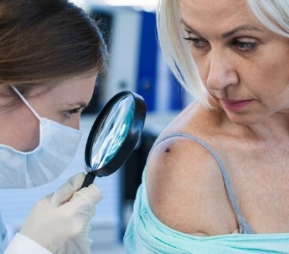 quels sont les premiers signes d'un cancer de la peau symptômes mélanome