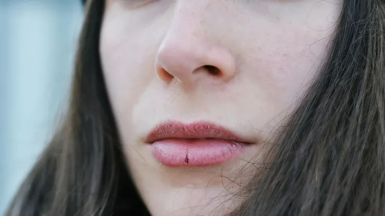 lèvres gercées que faire habitudes vie aideront garder lèvres douces hydratées