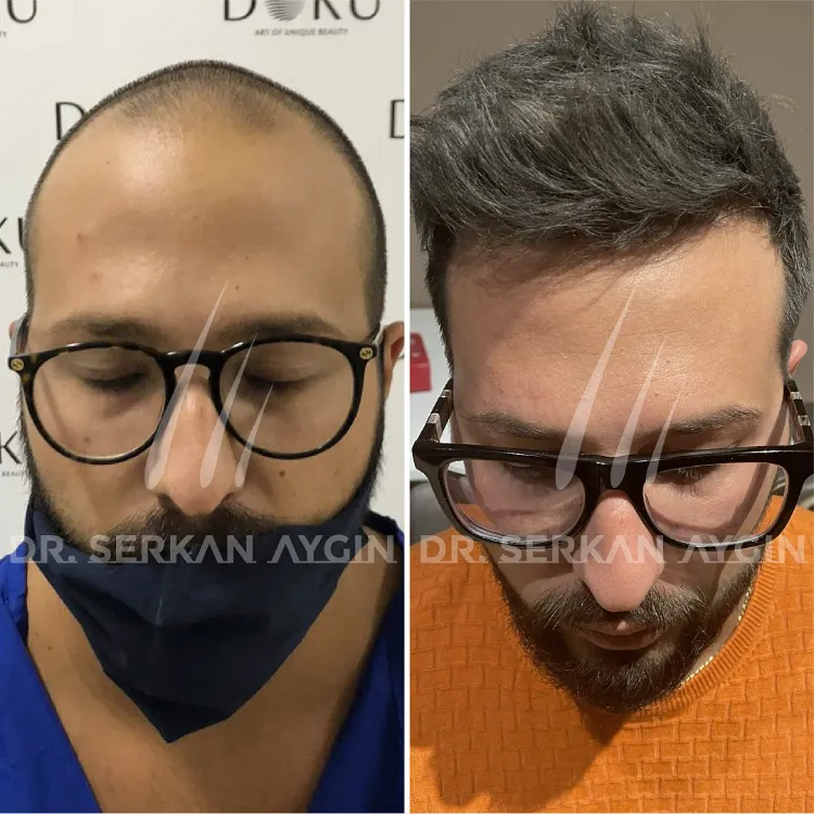 avantages greffe de cheveux Istanbul dr serkan aygin clinic prix tarif