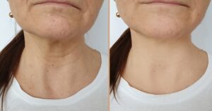 comment enlever naturellement les rides de la potrine femme 50 ans masque visage gommage massage exercices