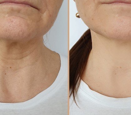 comment enlever naturellement les rides de la potrine femme 50 ans masque visage gommage massage exercices