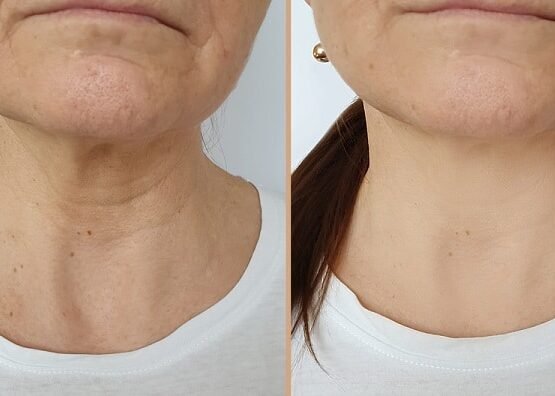 comment enlever naturellement les rides de la potrine femme 50 ans masque visage gommage massage exercices