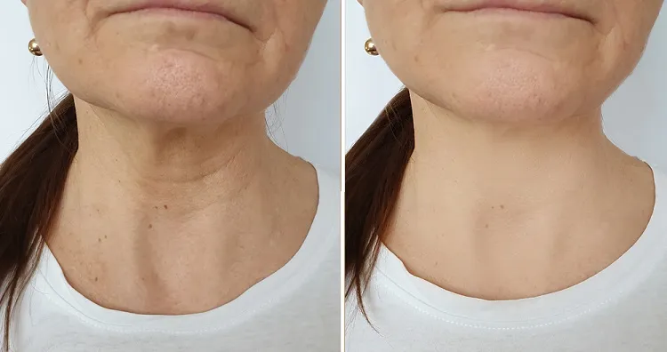 Comment rajeunir la peau du cou naturellement