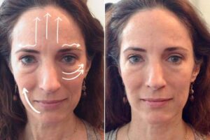 massage visage anti rides avant après