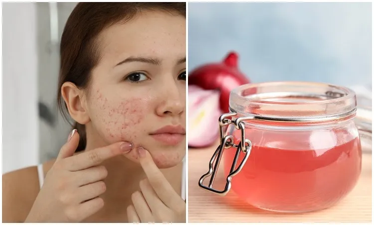 utilisation pelure d'oignon contre l'acné peau grasse 