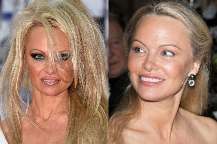 Pamela Anderson avant apres